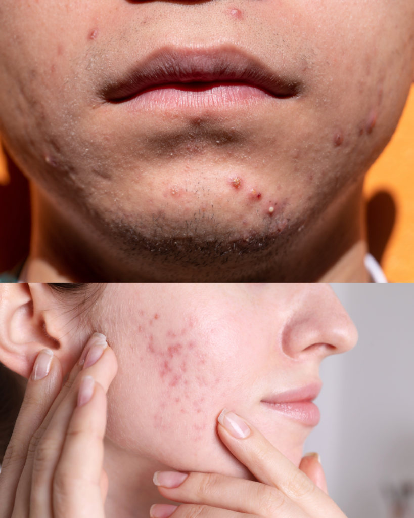 cystic-acne-treatment
