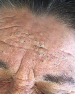 Get Rid of Pimples and Keep Them Away: Complete Acne Treatment Guide